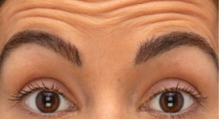 Botox Forehead Lines